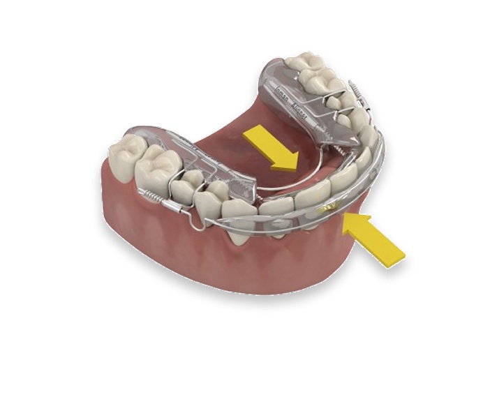 inman aligners inman aligners