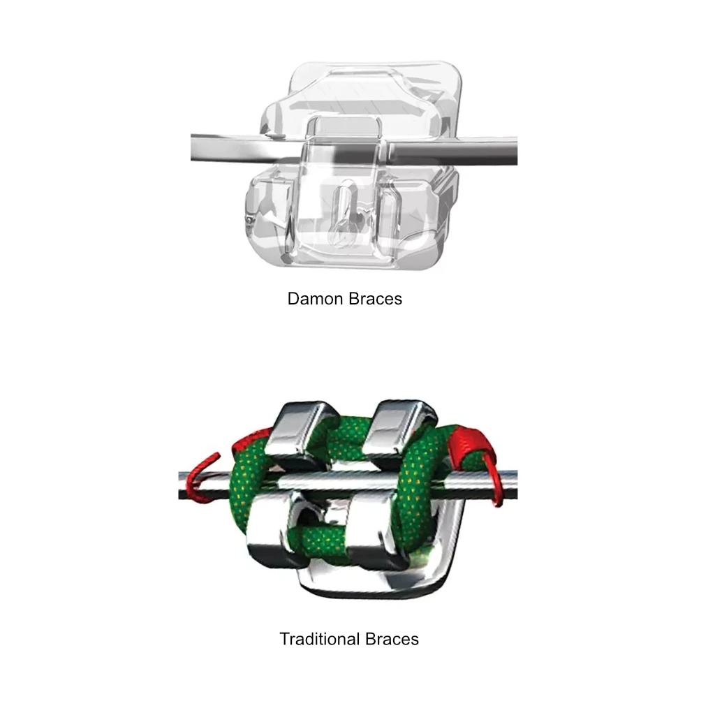 Damon vs traditional braces Damon vs traditional braces