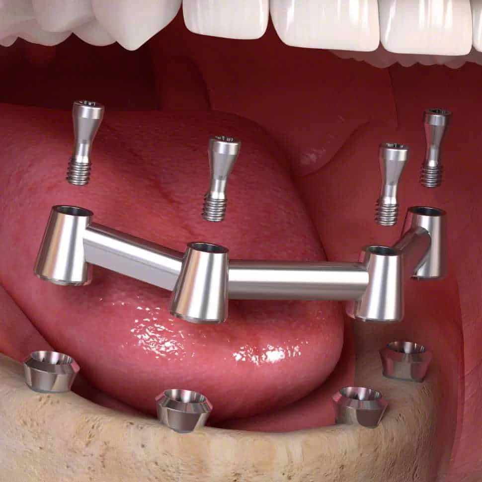 dental_implant_removable_bar