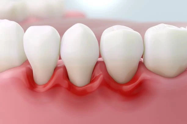 Gum disease treatment