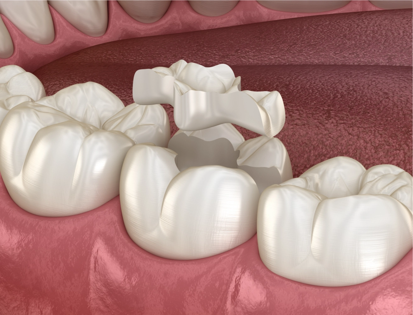 tooth onlay - inlay fillings