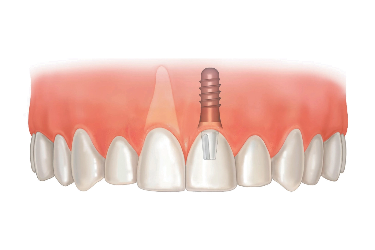 single_dental_implant