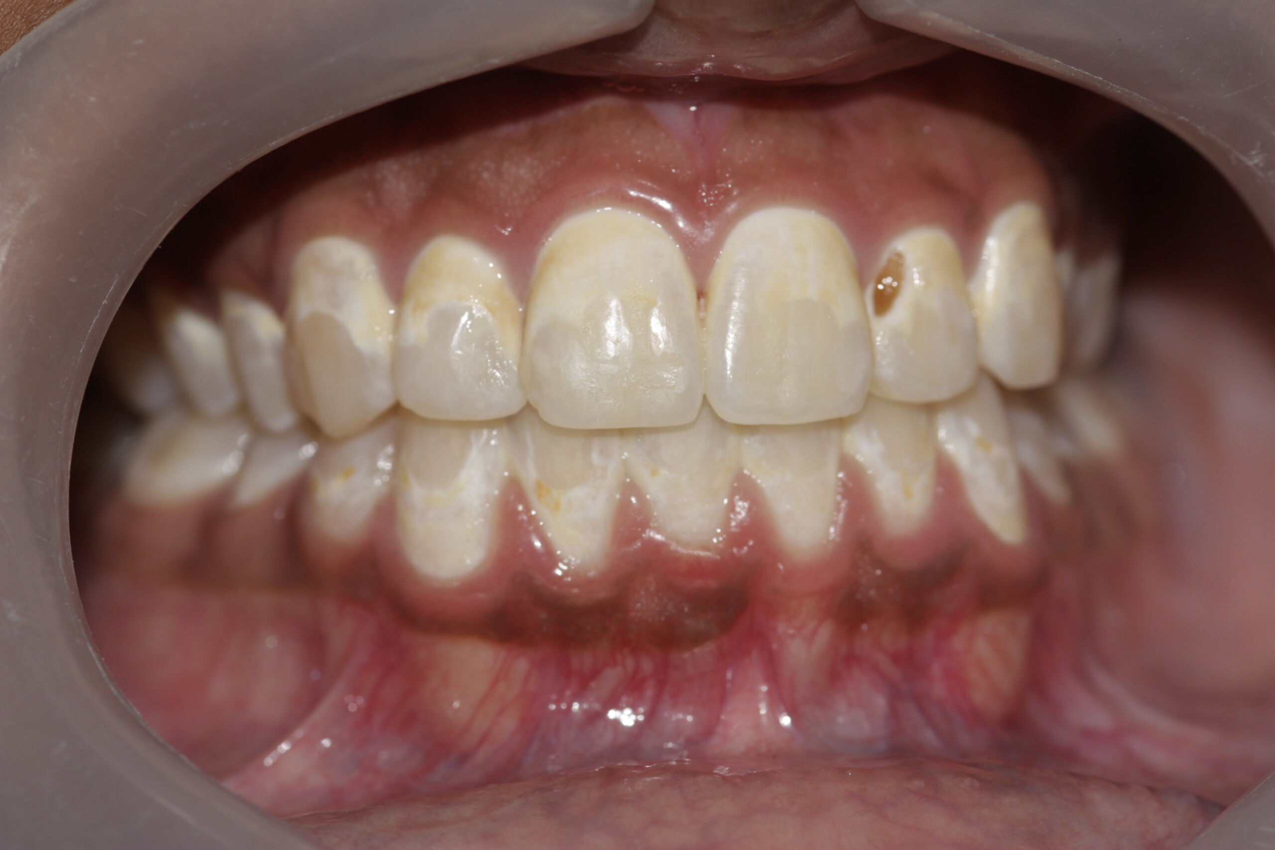 Close-up of teeth with white spot lesions around braces, showing early tooth decay caused by inadequate oral hygiene during orthodontic treatment.
